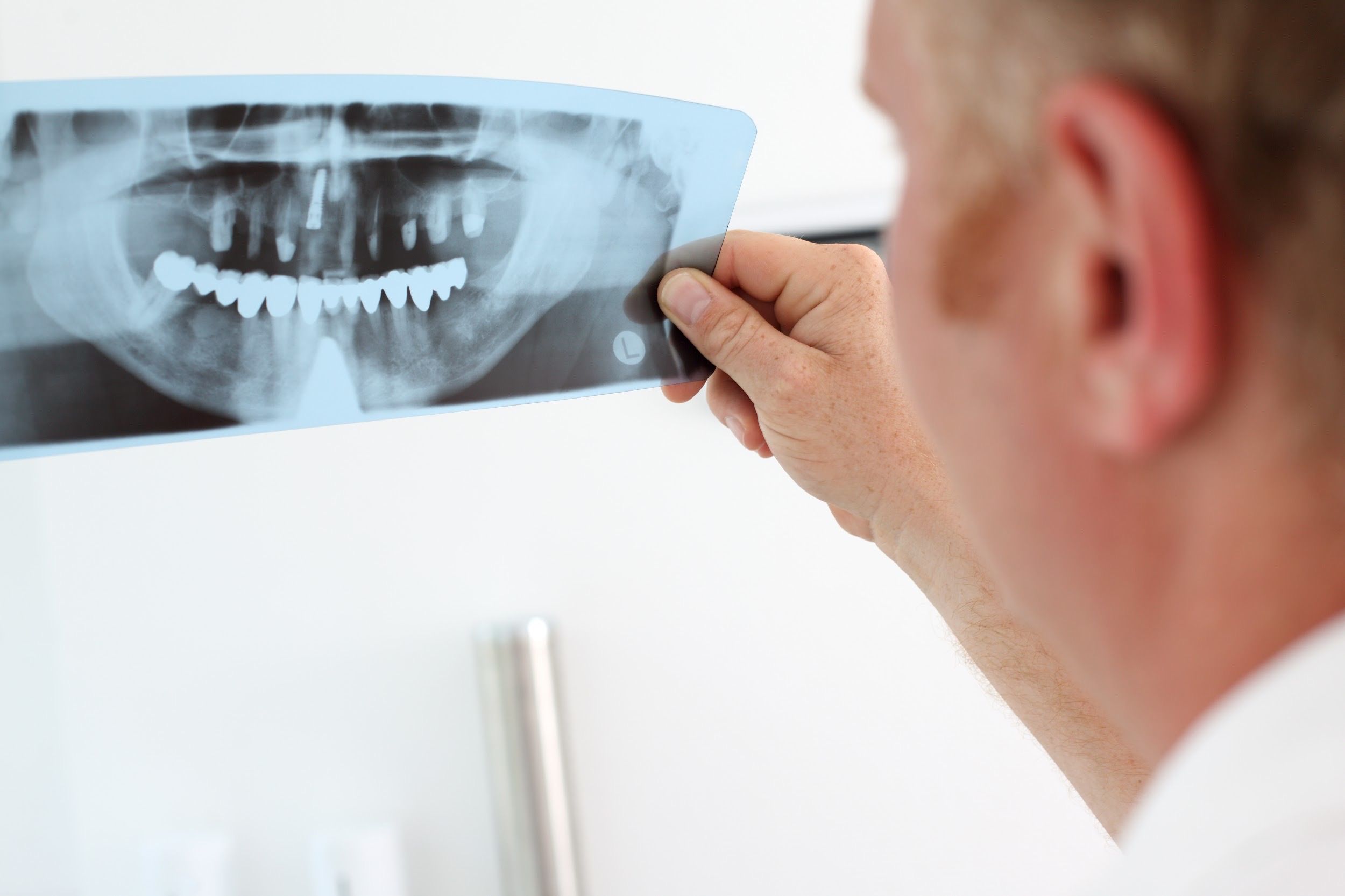 intervención de implantes dentales