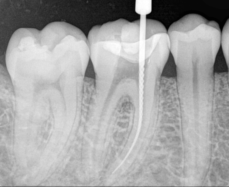 Endodoncia