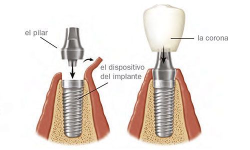 Partes de un implante dental