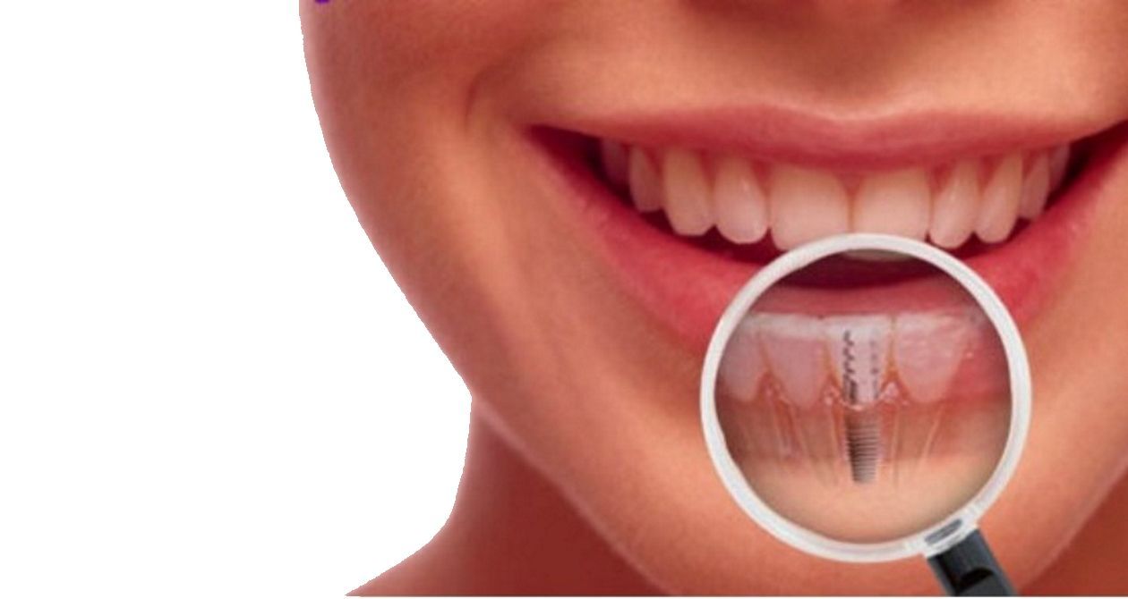 intervención de implantes dentales en Sevilla