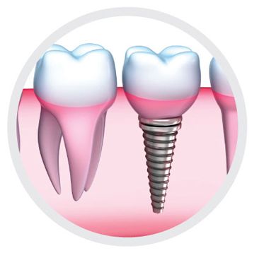 Dientes fijos con implante dental