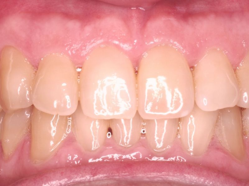 Blanqueamiento dental
