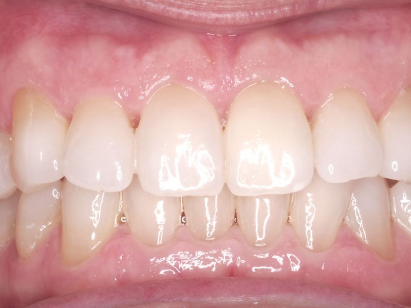 Blanqueamiento dental después. Casos clínicos dentales