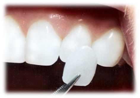 Carillas de porcelana. Implantación