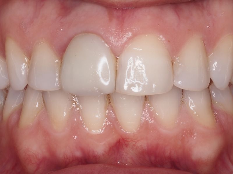 Fotografías del antes y despues en el dentista. Casos clínicos dentales