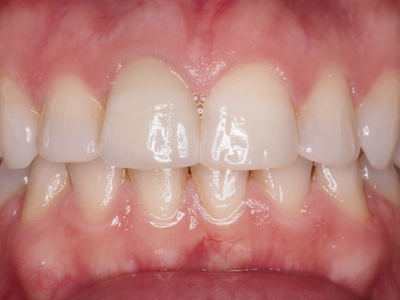 Carillas dientes