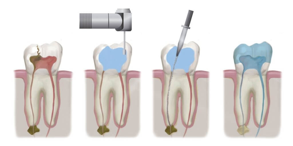 Endodoncia Imagen Endodoncia Imagen rayos x