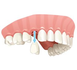 extracción de piezas dentales e implantación de dientes