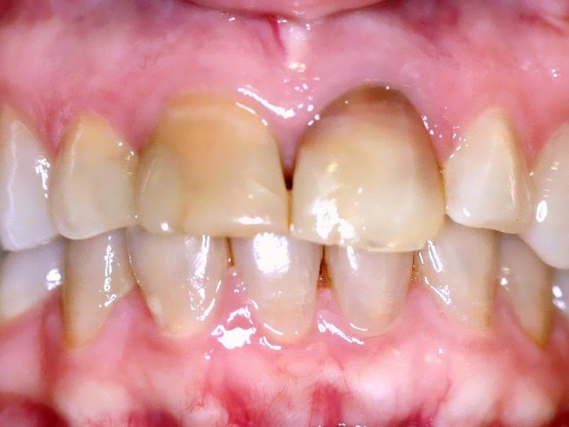 Blanqueamiento dental antes