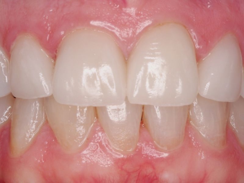 Blanqueamiento dental después