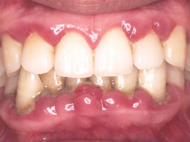 Periodoncia Sevilla antes