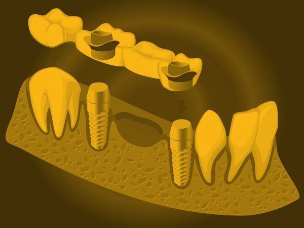 Implante dental Implante dental
