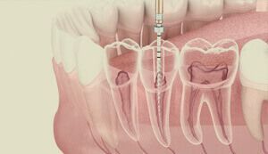 Endodoncia Sevilla