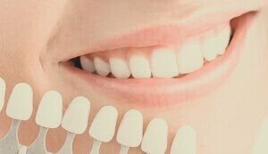 Estética dental Sevilla